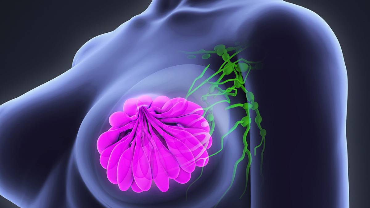 Eficacia de la acupuntura en el tratamiento del linfedema asociado al cáncer de mama