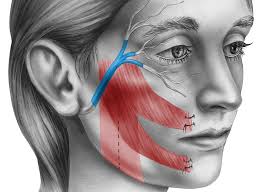 Eficacia de la acupuntura para el tratamiento de la parálisis facial