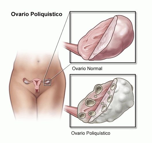 Eficacia de la acupuntura Tung para las hormonas sexuales en el síndrome del ovario poliquístico