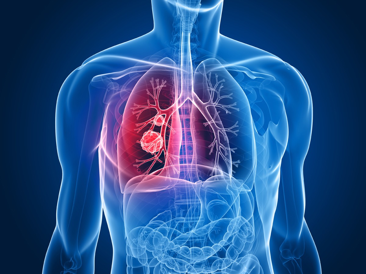 Acupuntura en el tratamiento de la enfermedad pulmonar obstructiva crónica: ensayo multicéntrico, aleatorizado y controlado
