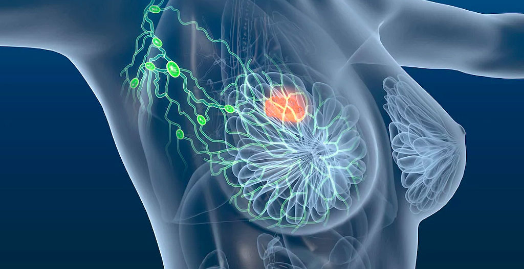 Acupuntura y moxibustión en el tratamiento del linfedema asociado a cáncer de mama: revisión sistemática y metanálisis
