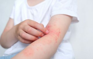 Acupuntura y eczema atópico: ¿Qué dice la evidencia científica?