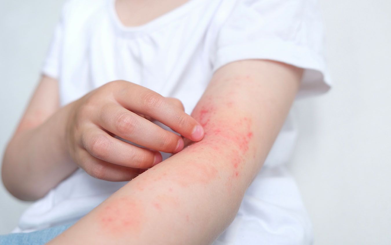 Acupuntura y eczema atópico: ¿Qué dice la evidencia científica?
