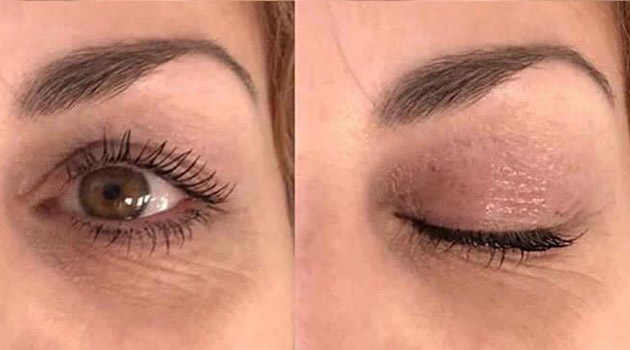 Rejuvenecimiento de la piel con tecnología Rejuvenecimiento de la piel con tecnología PLASMAGE