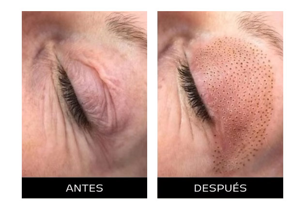 Rejuvenecimiento de la piel con tecnología PLASMAGE Rejuvenecimiento de la piel con tecnología PLASMAGE