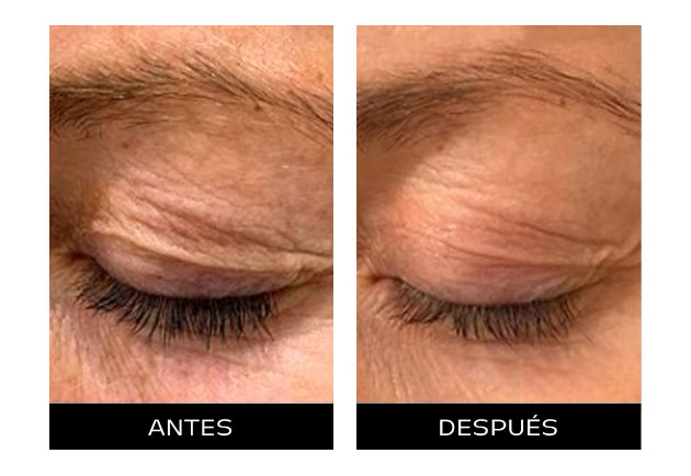 Rejuvenecimiento de la piel con tecnología PLASMAGE Rejuvenecimiento de la piel con tecnología PLASMAGE