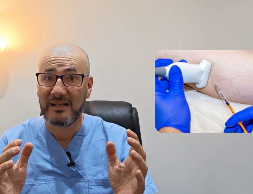 Fleboesclerosis eco-guiada con microespuma: un tratamiento cómodo, preciso y eficaz para las varices