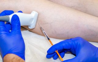 Fleboesclerosis eco-guiada con microespuma: un tratamiento cómodo, preciso y eficaz para las varices