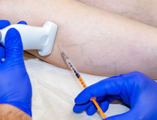 Fleboesclerosis eco-guiada con microespuma: un tratamiento cómodo, preciso y eficaz para las varices