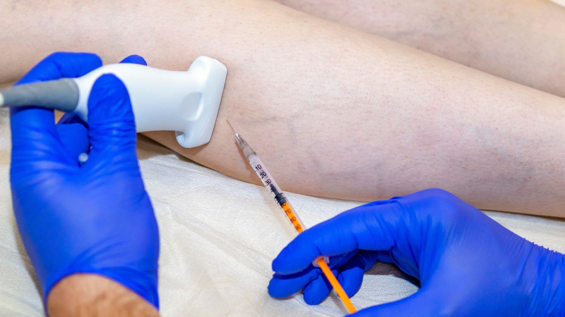 Doctor realizando una fleboesclerosis eco-guiada con microespuma en la pierna de un paciente.