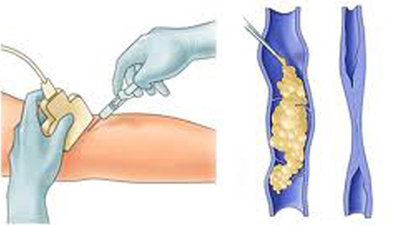Piernas sin varices tras el tratamiento de fleboesclerosis con microespuma.