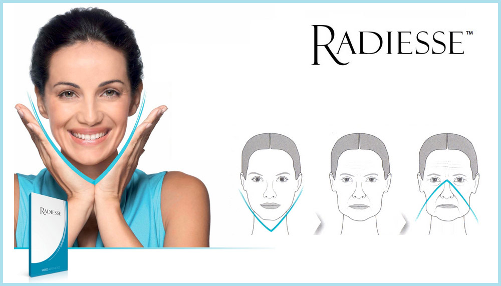 Radiesse: bioestimulación de colágeno con efecto lifting sin cirugía